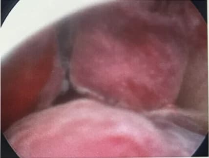 子宮鏡下子宮內膜息肉實際影像（一）