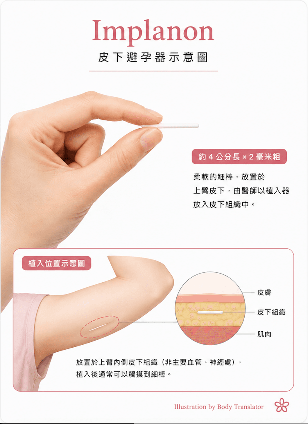 Implanon 皮下避孕器外觀與上臂皮下植入位置示意圖